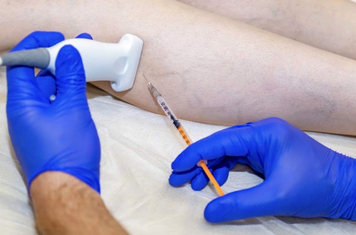 Escleroterapia ecoguiada con guantes azules